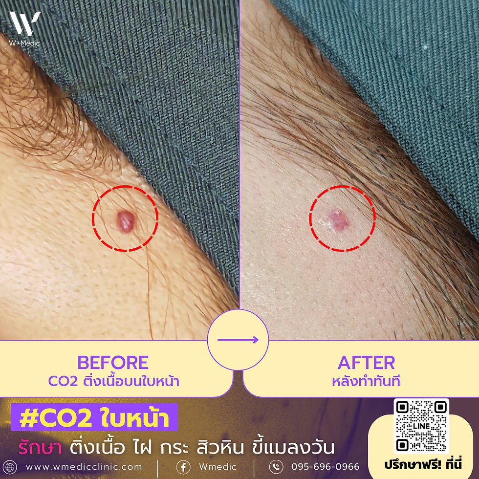 ติ่งเนื้อ