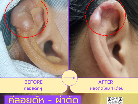 รีวิว ครบ 1 เดือนหลังตัดไหม แผลคีลอยด์หูดีขึ้นแค่ไหน! มาดูกัน ที่ W⁺ Medic Clinic 🎉