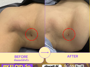 รีวิวจริง: ฉีดคีลอยด์ที่ W+ Medic Clinic