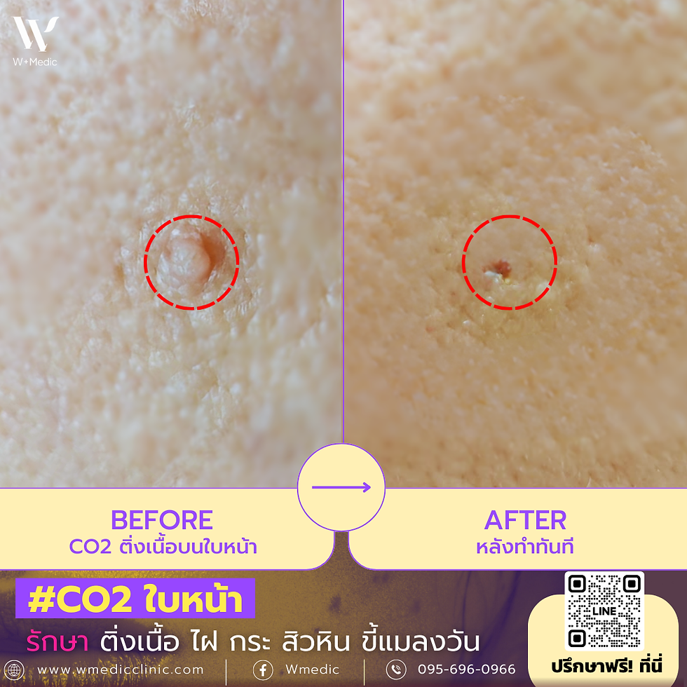 รีวิวรักษาติ่งเนื้อบนหน้า ด้วยเลเซอร์ CO2 ที่ W⁺ Medic Clinic นนทบุรี แบบสายมั่น!