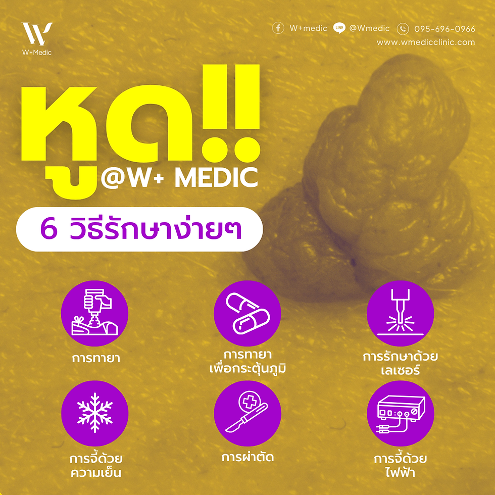หูด