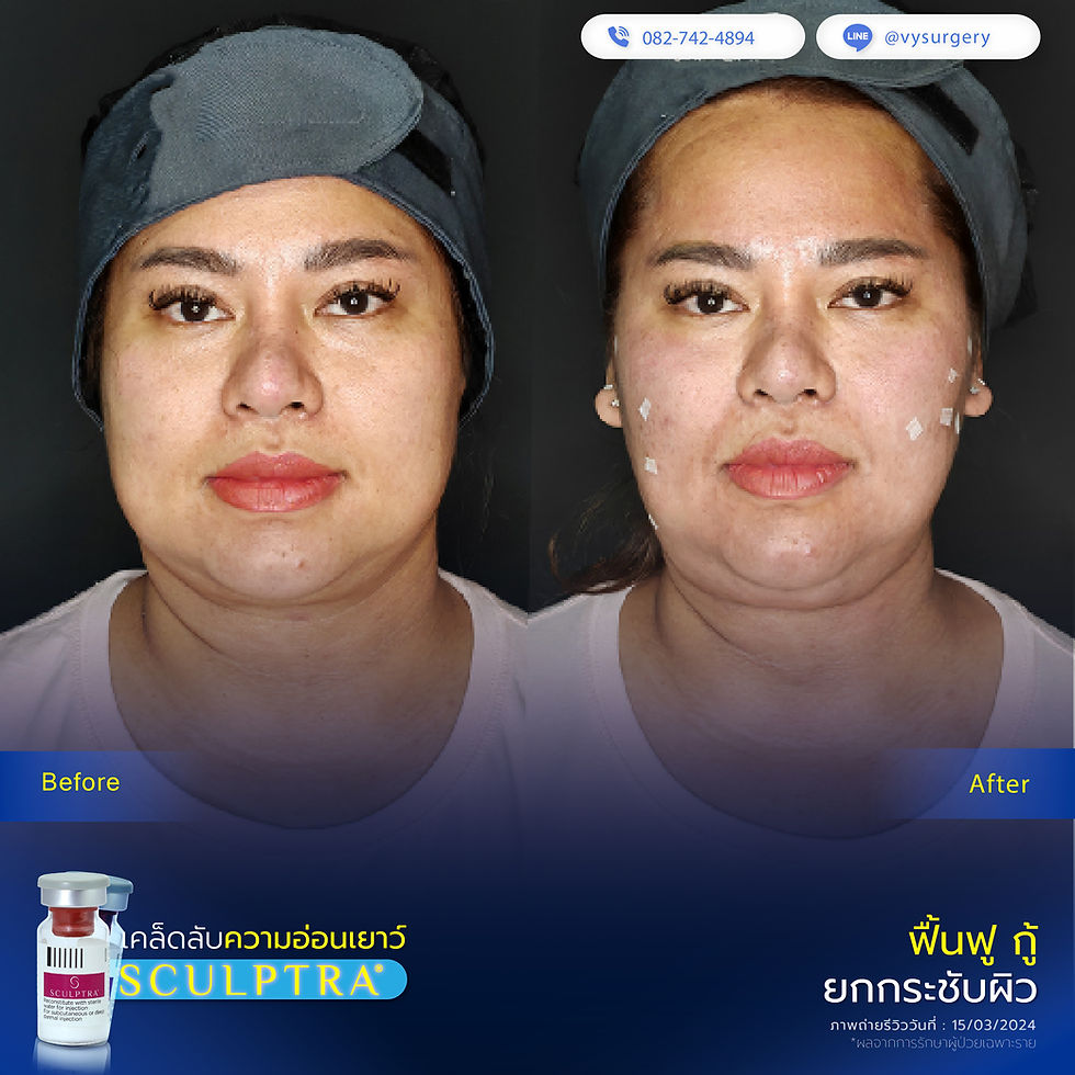 รีวิวหลังฉีด Sculptra ที่w medic นนทบุรี