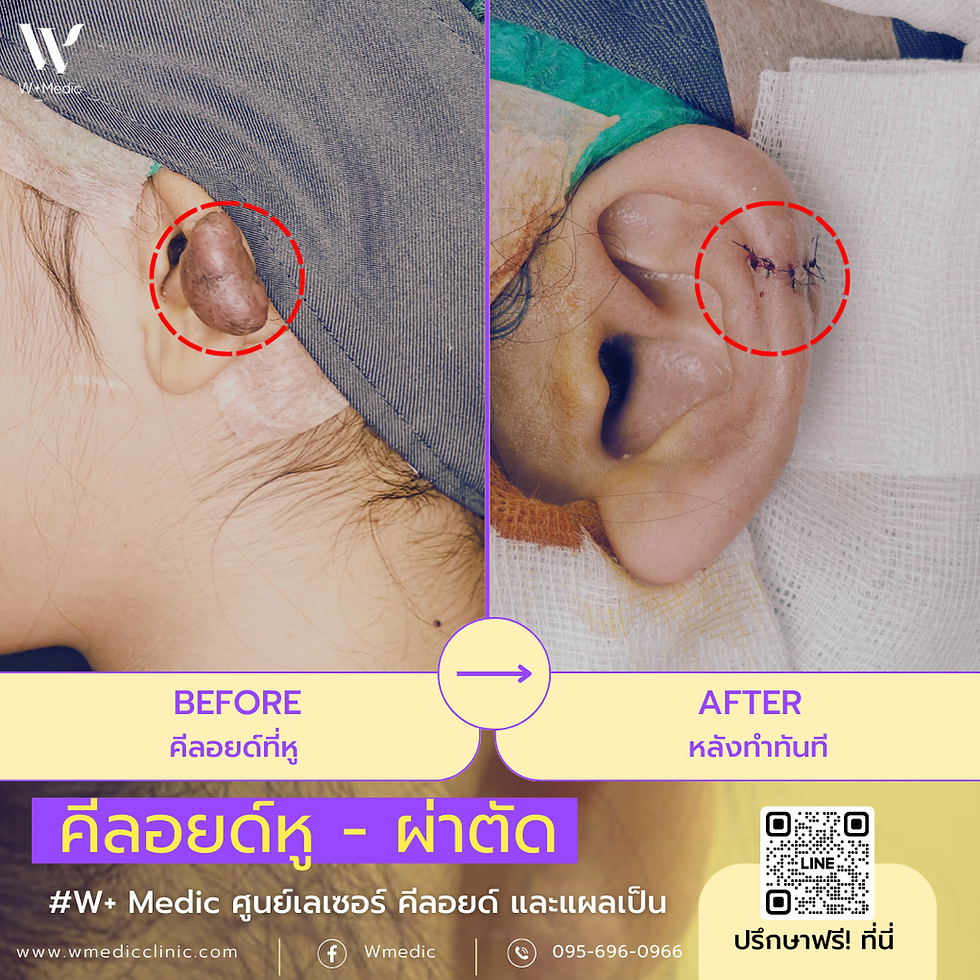ผ่าคีลอยด์หู