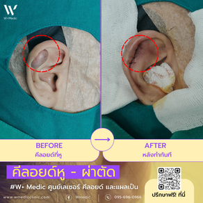 รีวิว ความรู้สึกแรกหลังผ่าตัดคีลอยด์หู... มันเบามากจริงๆ ที่ W+ Medic Clinic นนทบุรี👍