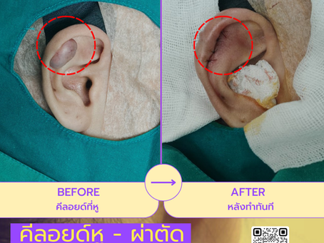 รีวิว ความรู้สึกแรกหลังผ่าตัดคีลอยด์หู... มันเบามากจริงๆ ที่ W+ Medic Clinic นนทบุรี👍