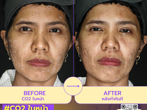 รีวิวเลเซอร์CO2 ใบหน้า – เคสกำจัดขี้แมลงวันและกระเนื้อ