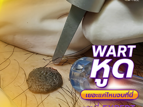 ผ่าตัดรักษา หูดขนาดใหญ่