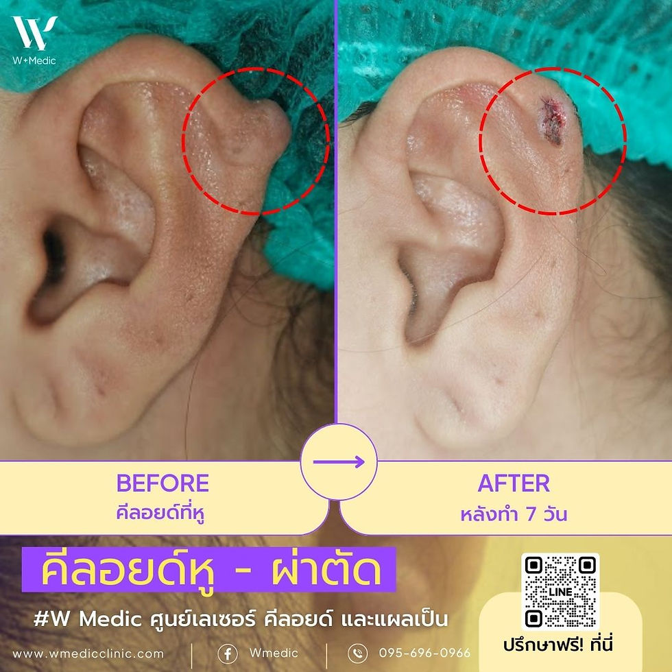 7วันหลังผ่าตัดคีลอยด์หูใหญ่มากก ไม่คิดว่าผลลัพธ์มันจะดีขนาดนี้!!
