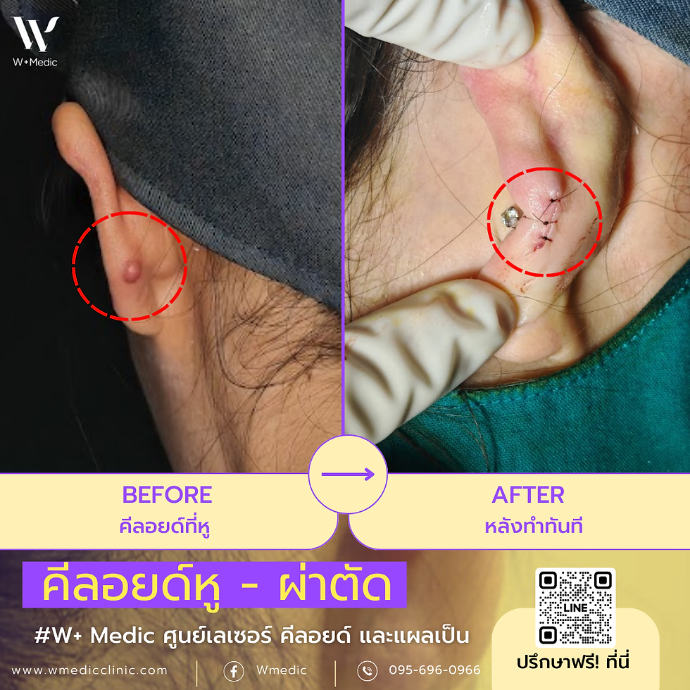 ผ่าตัดคีลอยด์หู