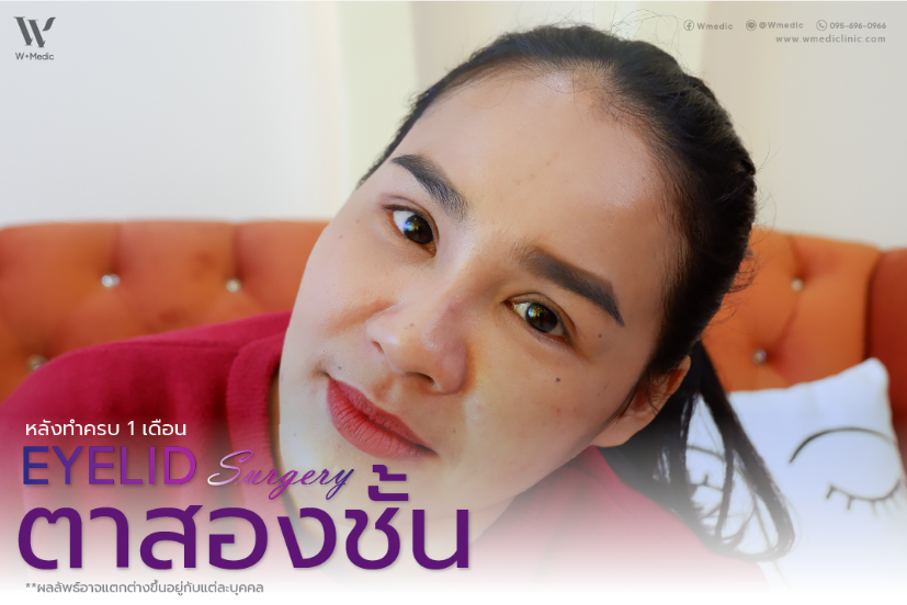 รีวิวทําตาสองชั้น