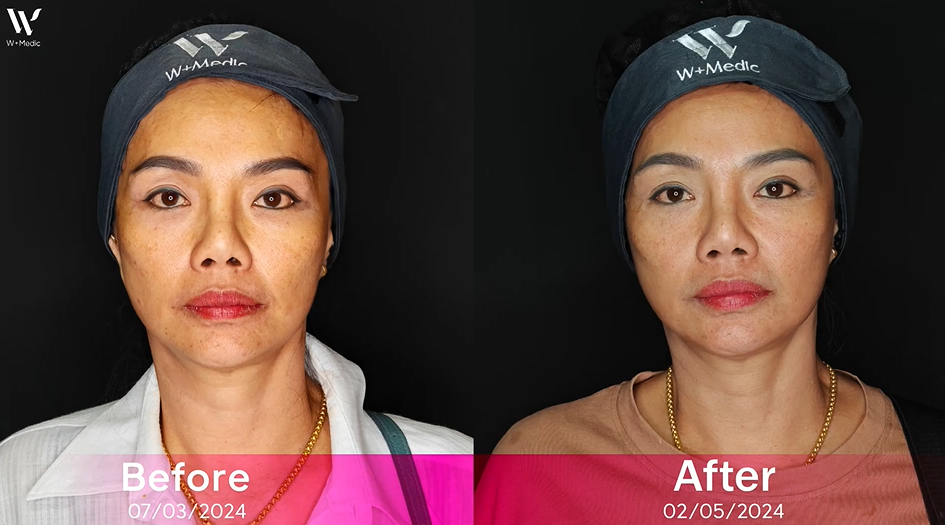 รีวิวหลังฉีดSculptra!หน้าตรง