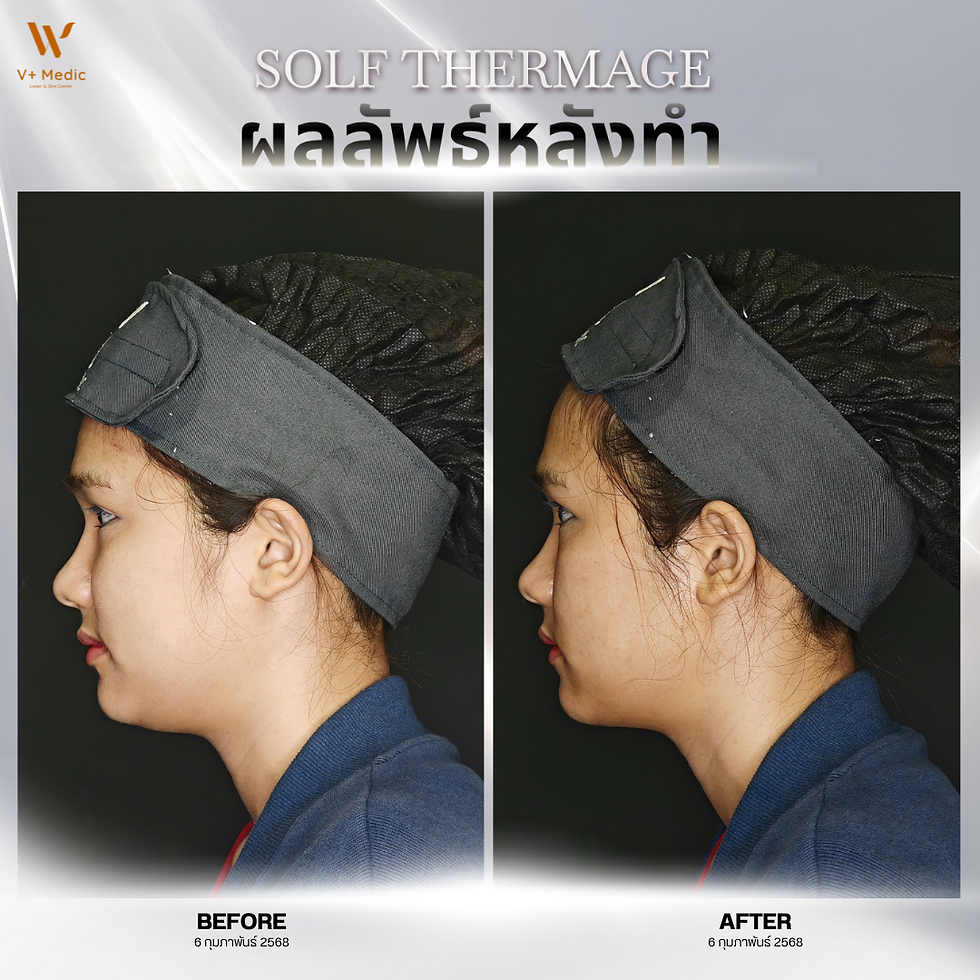 รีวิว ประสบการณ์กระชับหน้าSoft Thermage ผลลัพธ์ ยกกระชับผิวหน้า ไม่ต้องผ่าตัด!