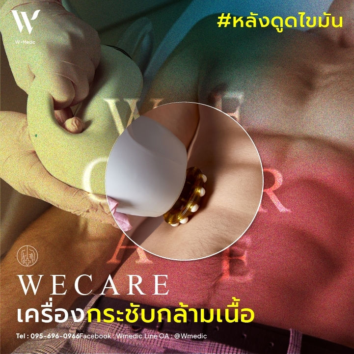 การใช้อุปกรณ์กระชับกล้ามเนื้อ ซึ่งเป็นนวัตกรรมที่ช่วยเสริมสร้างกล้ามเนื้อและปรับรูปร่างให้ดูดีขึ้นอย่างมีประสิทธิภาพ.