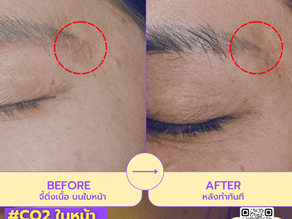 แก้ปัญหาด้วย เลเซอร์CO2 | ปัญหาติ่งเนื้อเล็ก ๆ บนใบหน้า อาจดูเหมือนเรื่องเล็ก แต่สำหรับหลายคนกลับเป็นสิ่งที่ทำให้เสียความมั่นใจ โดยเฉพาะเวลาต้องเจอผู้คนใกล้ ๆ