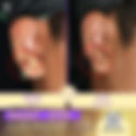 คีลอยด์ที่หู ดูแลรักษายังไงดี