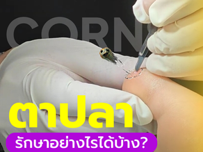 ตาปลา รักษาอย่างไรได้บ้าง? 👣