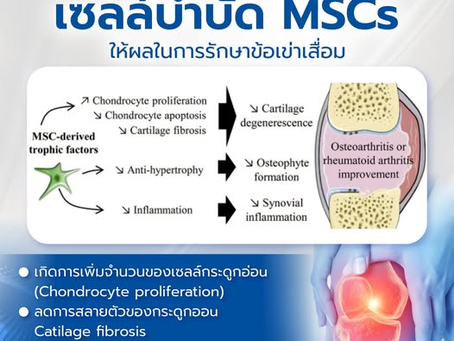การวิจัยพบว่า… เซลล์บำบัด MSCs ช่วยฟื้นฟูข้อเข่าเสื่อมได้จริง
