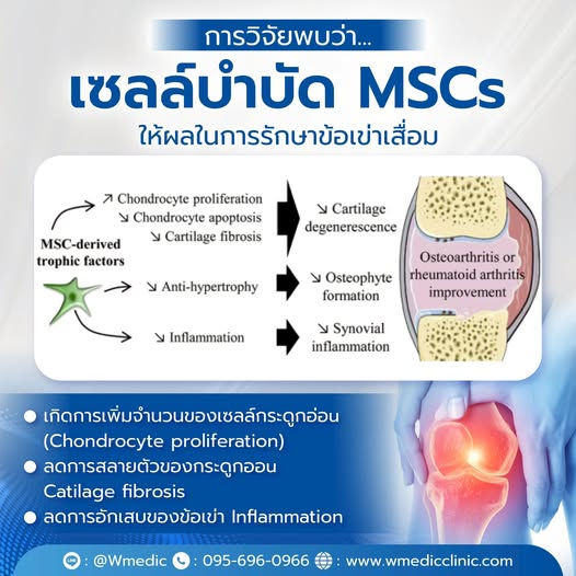 การวิจัยพบว่า… เซลล์บำบัด MSCs ช่วยฟื้นฟูข้อเข่าเสื่อมได้จริง