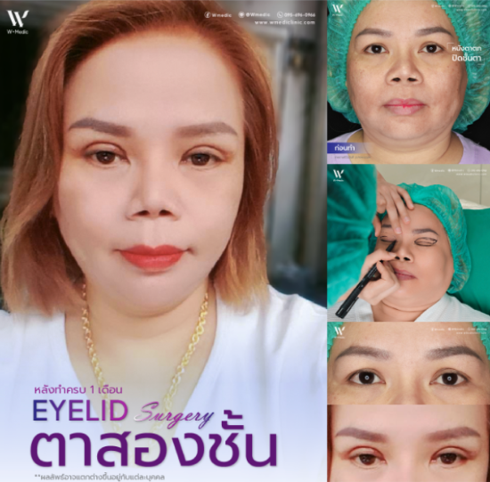 ทําตาสองชั้น รีวิวหลังทําผ่านไป 1 เดือน