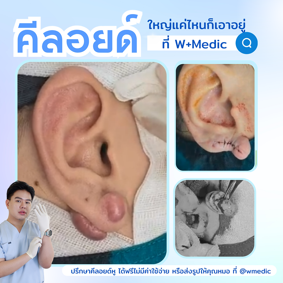 คีลอยด์หู
