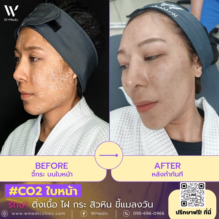 เลเซอร์CO2