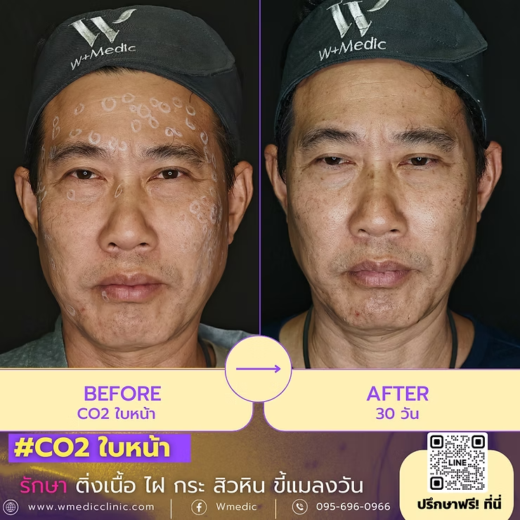 เลเซอร์CO2