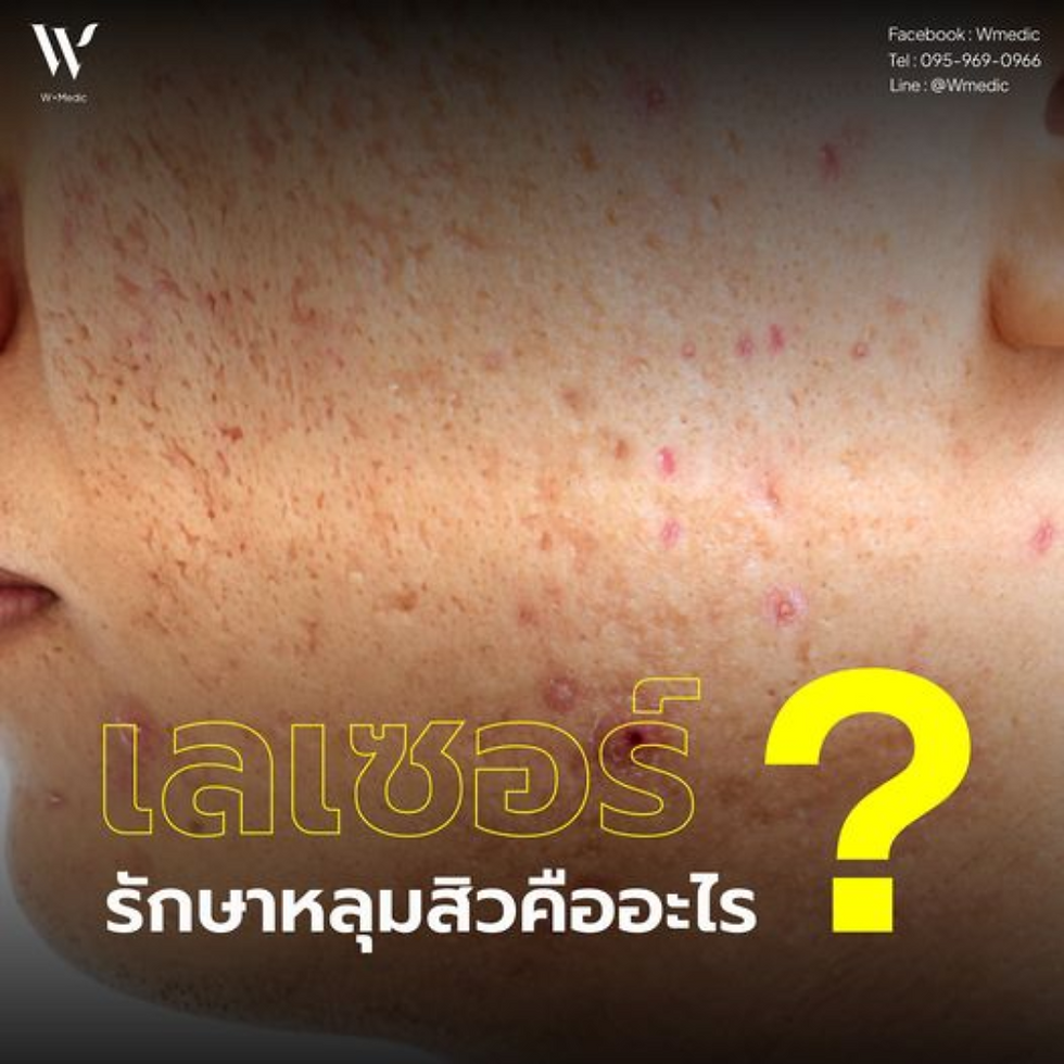 เลเซอร์หลุมสิว ปัญหาผิวหน้าที่เกิดจากการเป็นสิวอย่างหนัก ที่เผลอไปจับ แคะ แกะ หรือเการะหว่างที่สิวยังไม่หาย