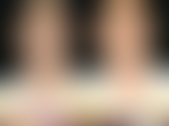 รีวิว เลเซอร์CO2 ใบหน้า – เคสคุณผู้ชายกังวลกระและไฝ