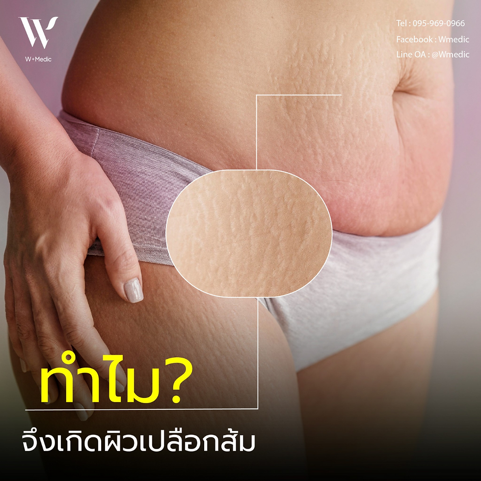 เซลลูไลท์ หรือ ผิวเปลือกส้ม เกิดจากอะไร? ผิวเปลือกส้ม (Orange Peel Skin) คือสภาพผิวที่มีลักษณะไม่เรียบเนียน คล้ายกับผิวของผลส้ม มีรูขุมขนกว้างและพื้นผิวที่ไม่สม่ำเสมอ ปัญหานี้พบได้บ่อยในทั้งผู้ชายและผู้หญิง