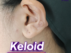ก้อนคีลอยด์เล็กๆ ที่เคยทำให้ไม่กล้ารวบผม วันนี้เริ่มเรียบลงแล้วค่ะ
