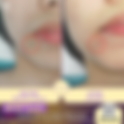 รีวิวกำจัดขี้แมลงวันบนหน้า ดูเนียนมากที่ w+medic