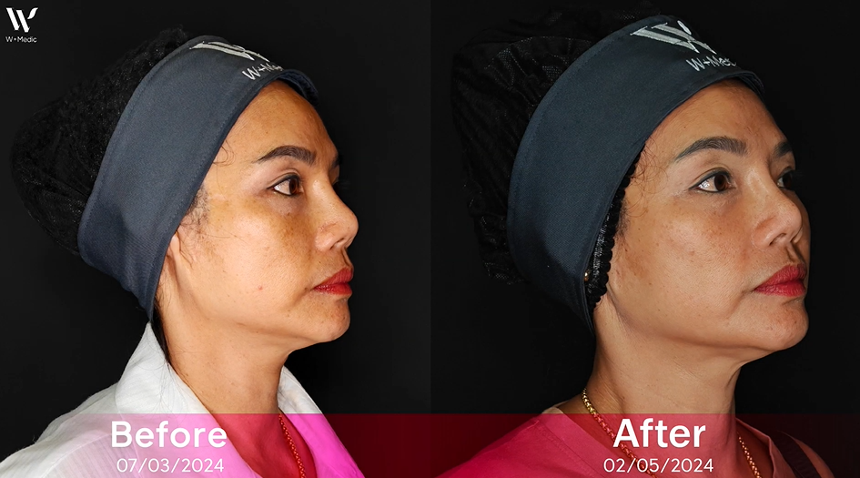 รีวิวหลังฉีดSculptra หน้าด้านข้าง