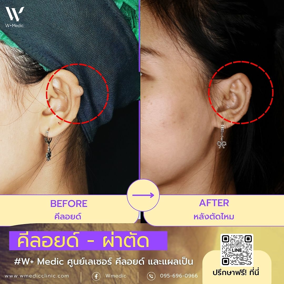 คีลอยด์