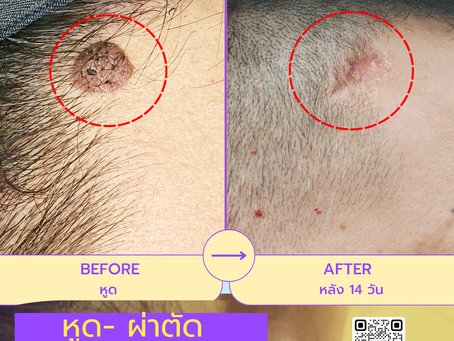 รีวิว 14 วันหลังผ่าตัดหูด ที่ W⁺ Medic Clinic นนทบุรี✨เห็นผลแค่ไหน มาดูกัน!