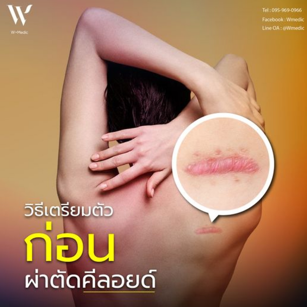 คีลอยด์ (Keloid) คือแผลเป็นนูนที่เกิดจากการเจริญเติบโตของเนื้อเยื่อแผลเกินกว่าขอบเขตเดิม ซึ่งอาจทำให้เกิดความไม่สบายใจหรือปัญหาเรื่องความสวยงาม