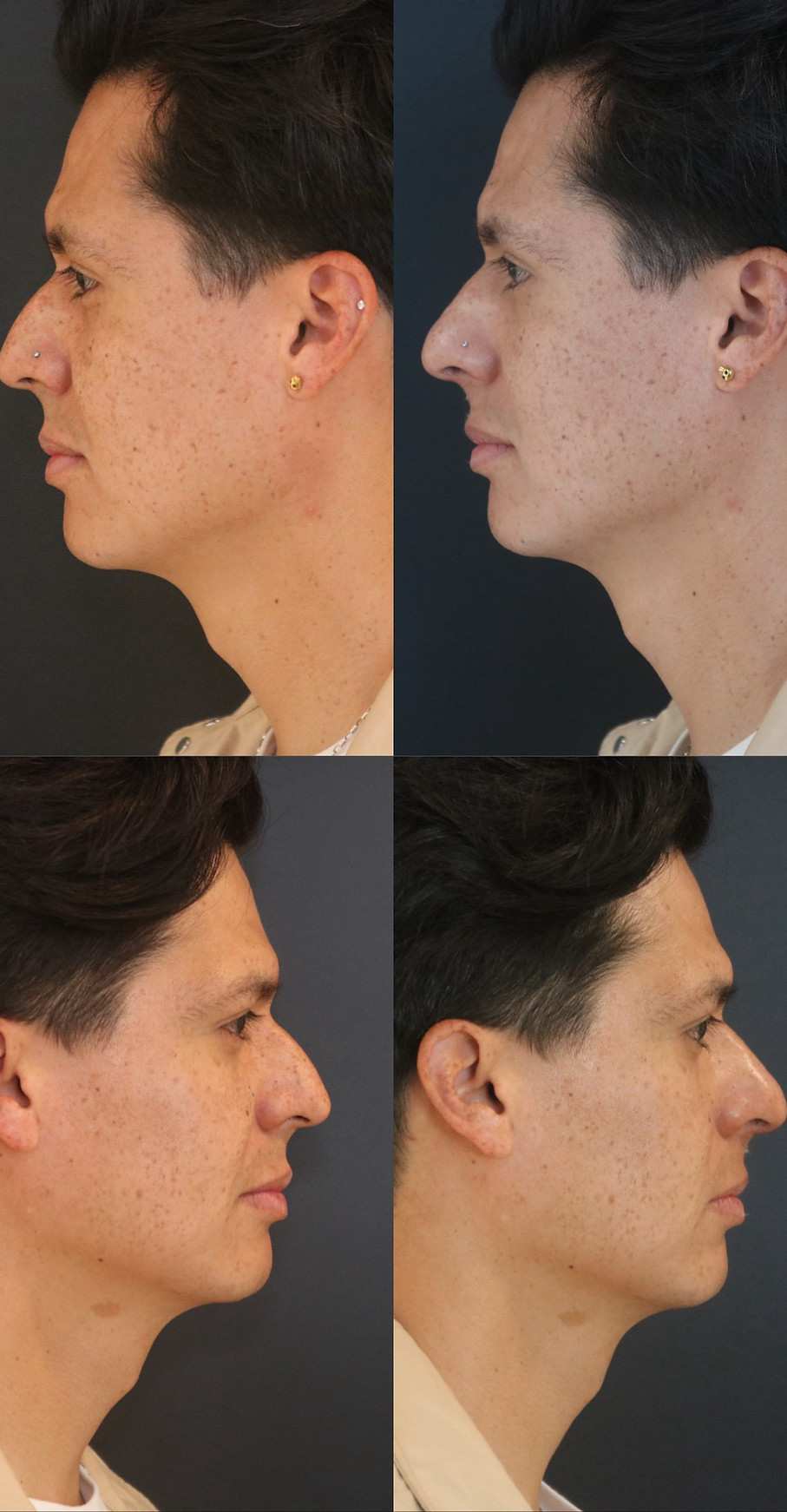 Antes y Después – Aplicación de rellenos faciales en Roma Norte, CDMX