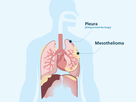 Mesothelioma