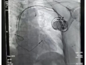 甚麼是心臟起搏器?