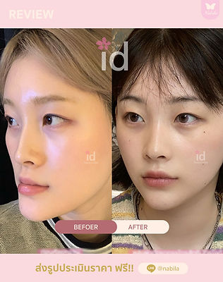 นาบิลา-เซอเจอรี่-nabila-surgery-ศัลยกรรมเกาหลี-รพ.-เอโตน-etonne-แก้จมูก-เกาหลี-ทำจมูก-เกาห