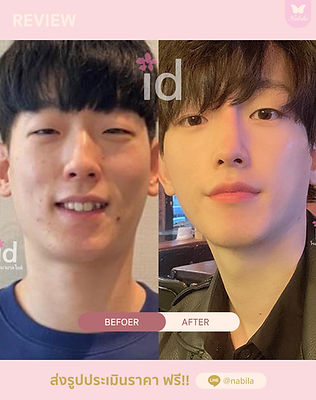 นาบิลา-เซอเจอรี่-nabila-surgery-ศัลยกรรมเกาหลี-รพ.-เอโตน-รีวิว-แก้จมูก-เกาหลี-ทำจมูก-เกาหล