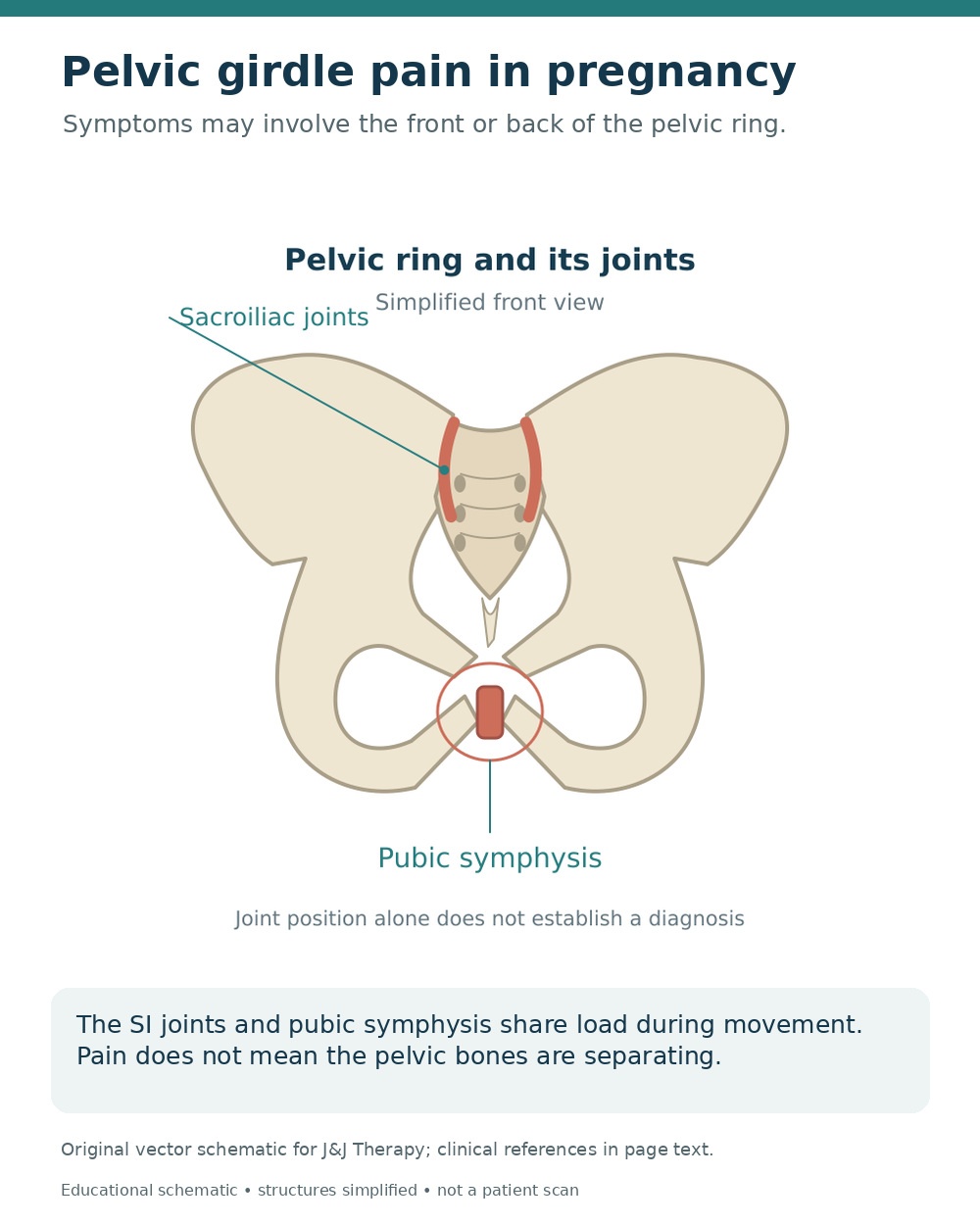 Simplified pelvic ring anatomy highlighting both sacroiliac joints and the pubic symphysis.