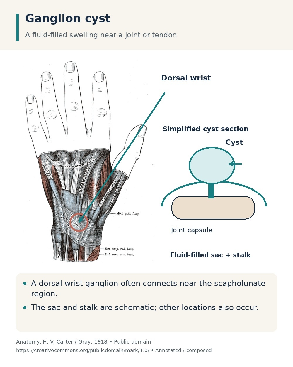 Dorsal wrist tendon anatomy with a separate schematic showing a fluid-filled ganglion sac connected by a stalk to a joint capsule.