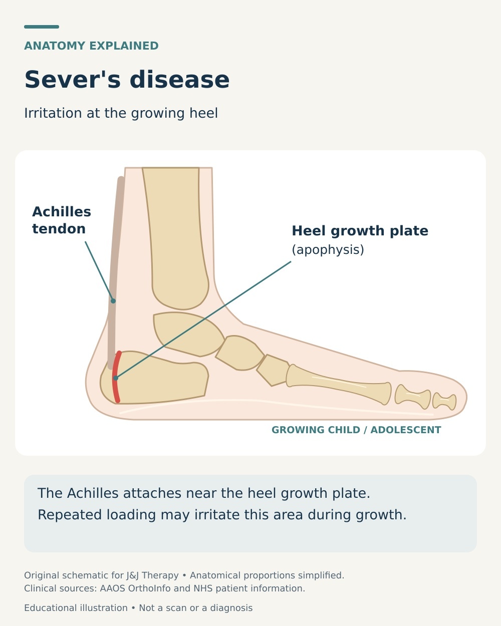 Growing heel anatomy showing the Achilles tendon and calcaneal growth plate affected by Sever’s disease.