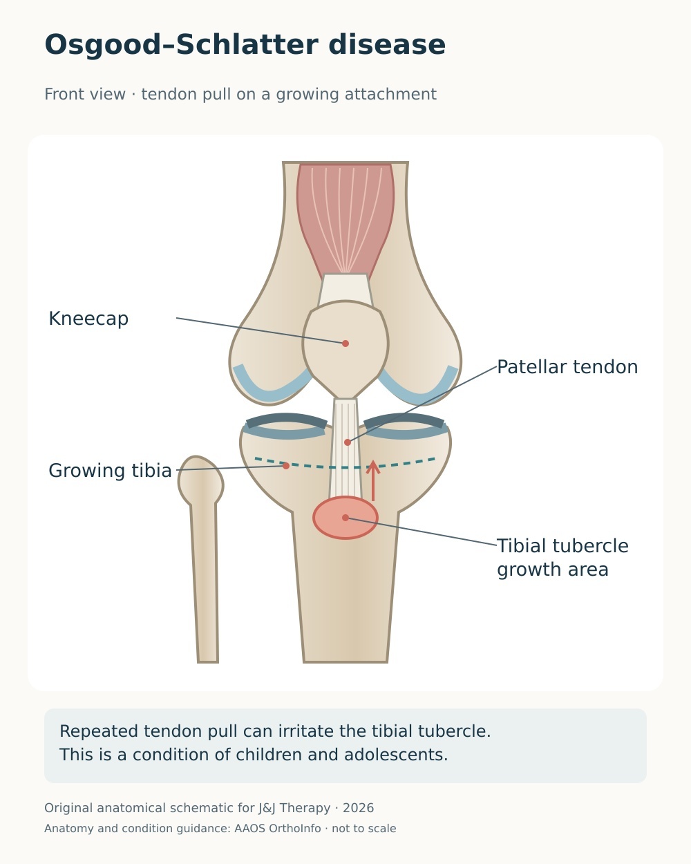 Anterior knee diagram showing patellar-tendon traction at the tibial tubercle growth area in an adolescent knee.