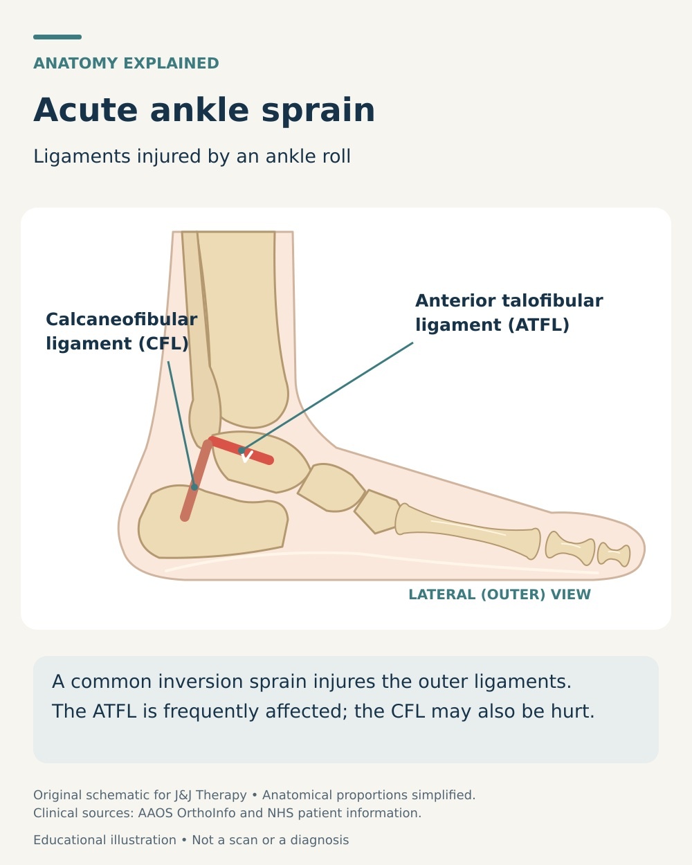 Outer ankle ligament anatomy showing the anterior talofibular and calcaneofibular ligaments involved in a common inversion sprain.