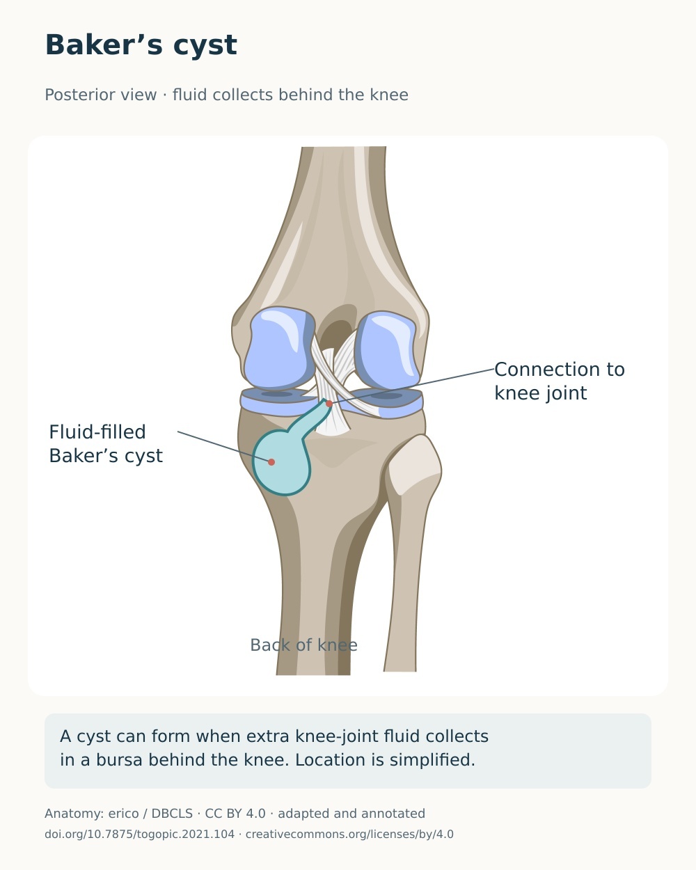 Posterior knee anatomy with a fluid-filled Baker’s cyst and its connection to the joint illustrated.