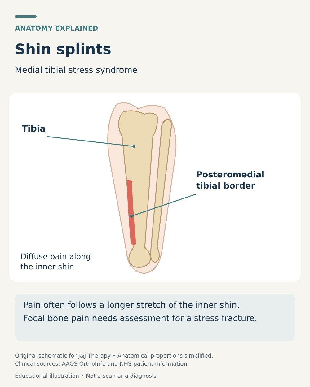 Shin splints diagram highlighting a longer painful region along the posteromedial border of the tibia.