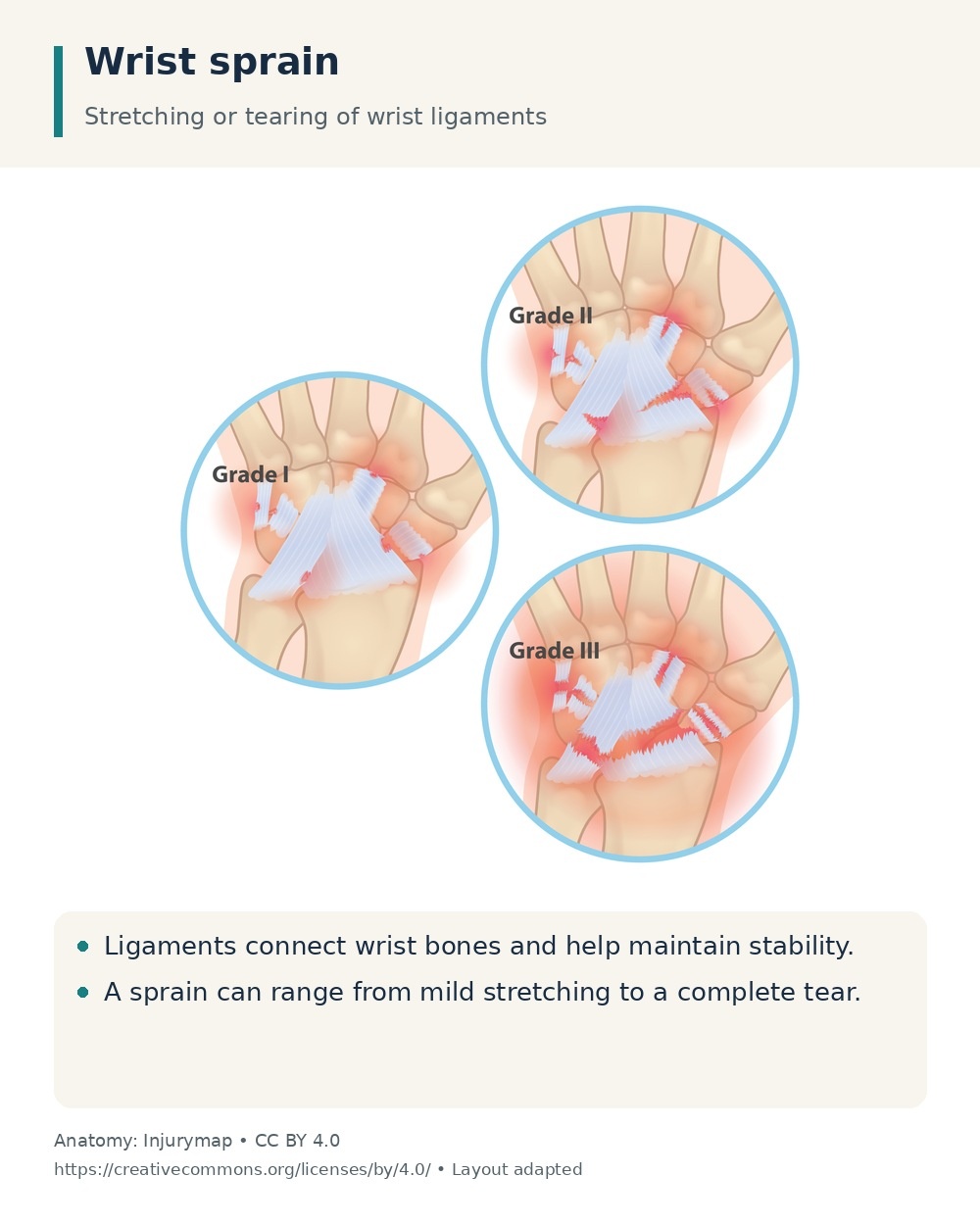 Three illustrations showing mild, partial and complete wrist ligament injury in a sprain.