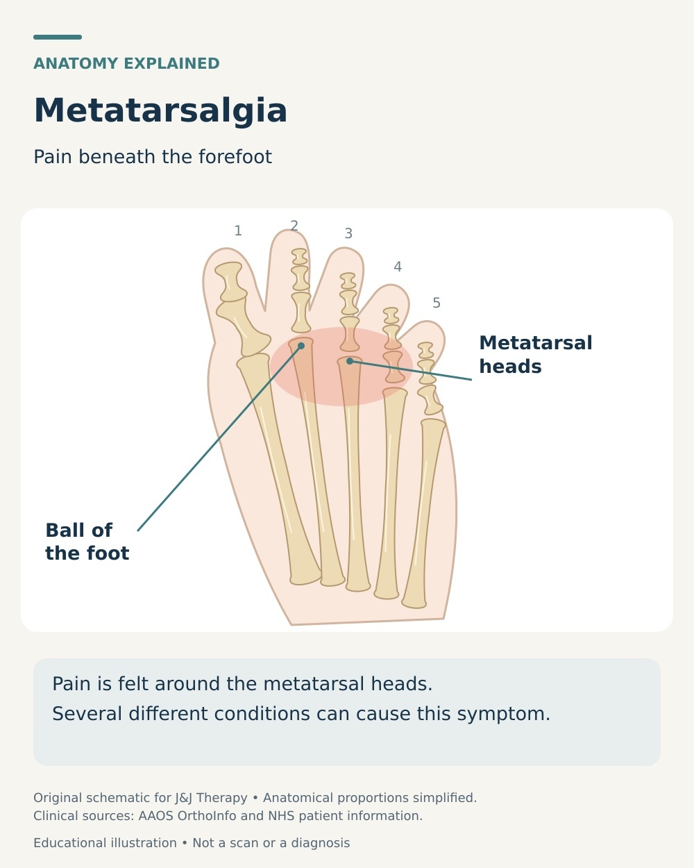 Plantar forefoot anatomy showing the metatarsal heads and the ball-of-foot region affected by metatarsalgia.