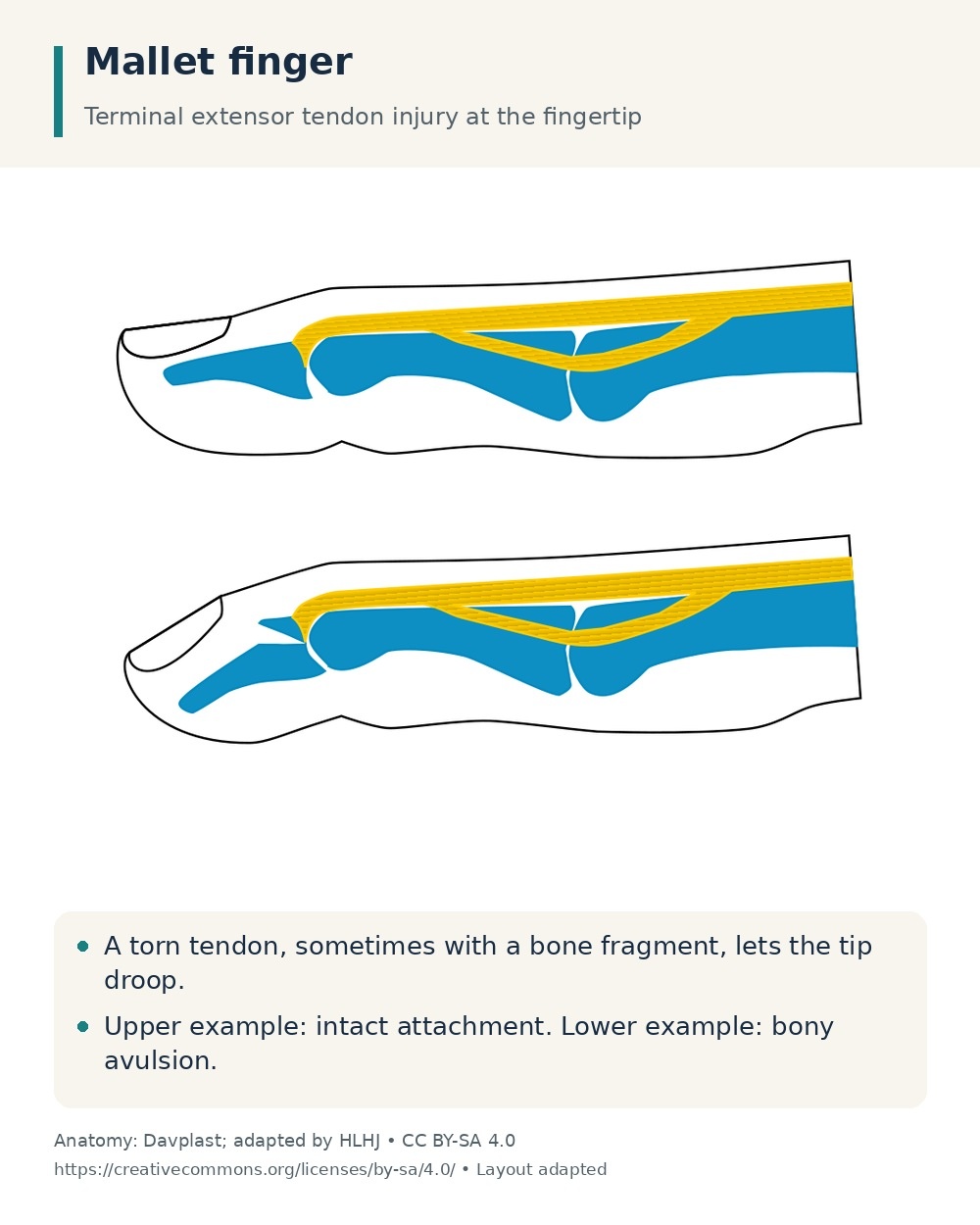 Terminal finger extensor mechanism comparing an intact attachment above with a bony avulsion and drooping fingertip below.